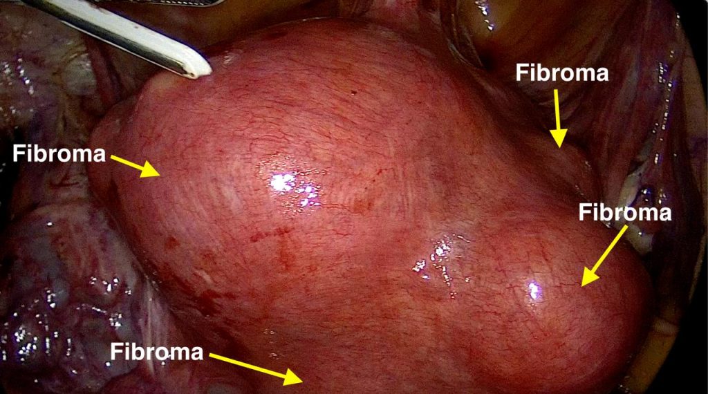 momento de extracción de fibroma durante una miomectomia laparoscopica.