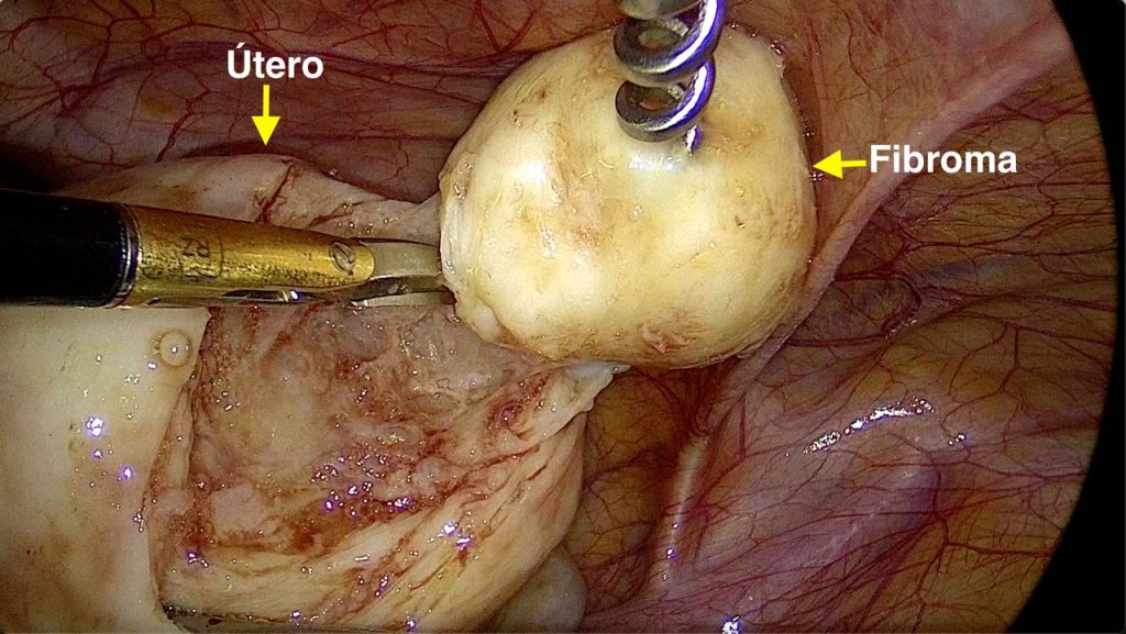 Utero con multiples fibromas.