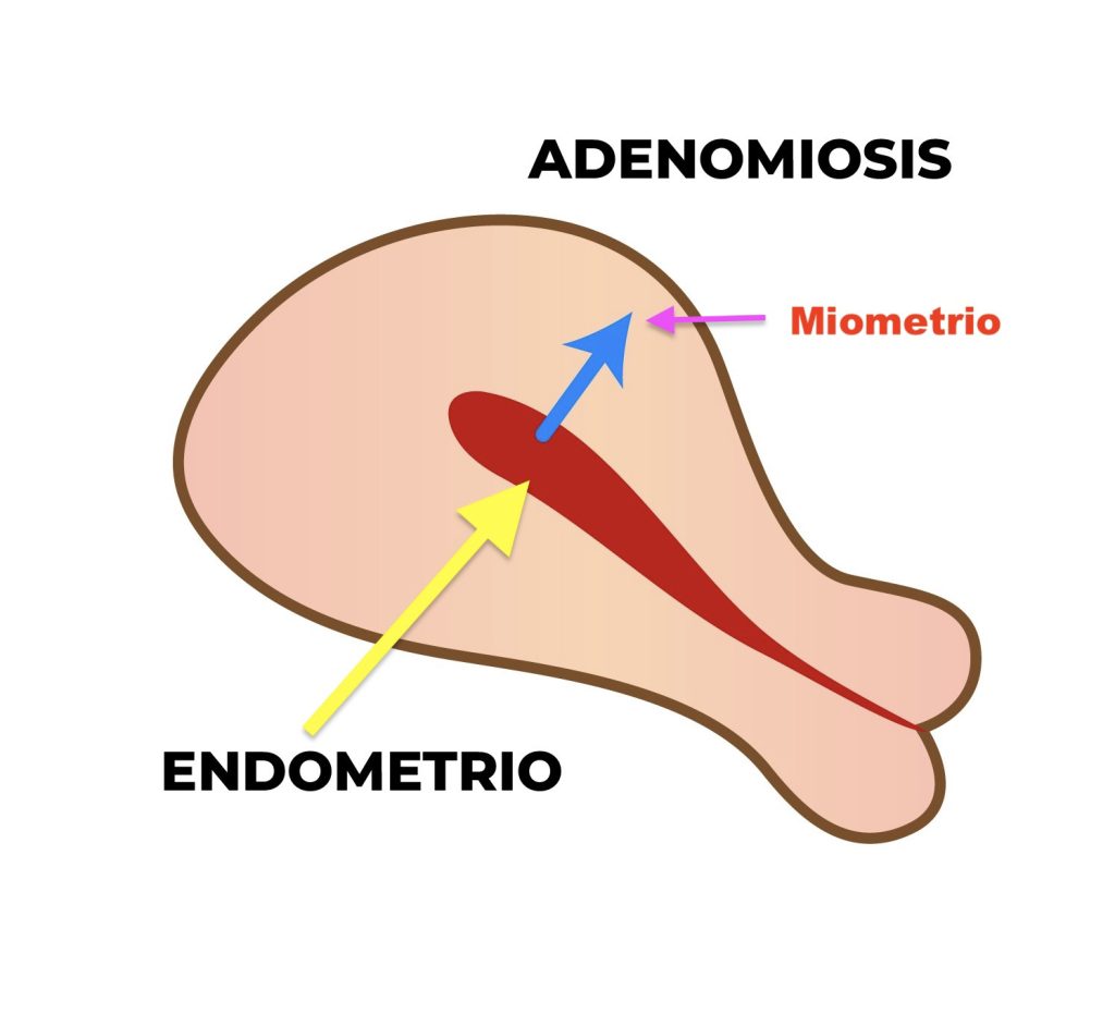 ADENOMIOSIS