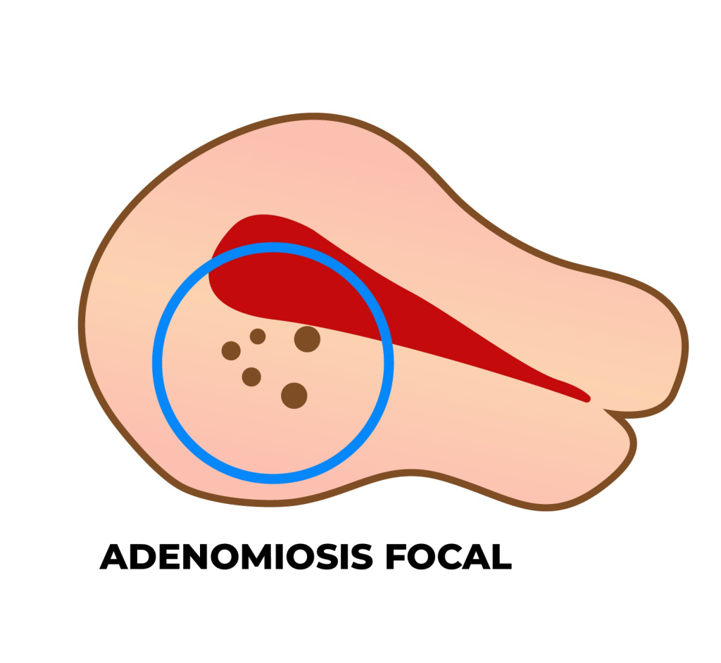 ADENOMIOSIS FOCAL