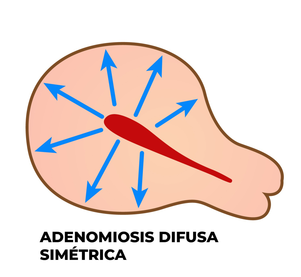 ADENOMIOSIS DIFUSA SIMETRICA