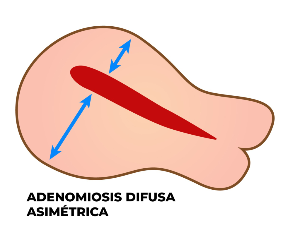 ADENOMIOSIS DIFUSA ASIMÉTRICA